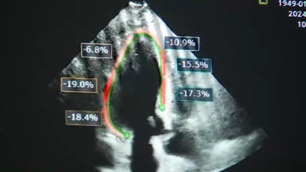 How Cardio-Oncology Transformed the Journey for a Fort Myers Breast Cancer Patient