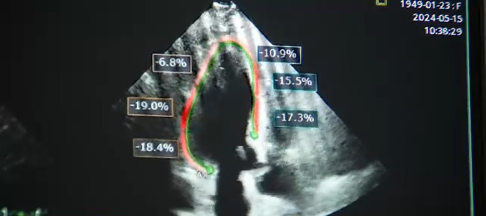 How Cardio-Oncology Transformed the Journey for a Fort Myers Breast Cancer Patient